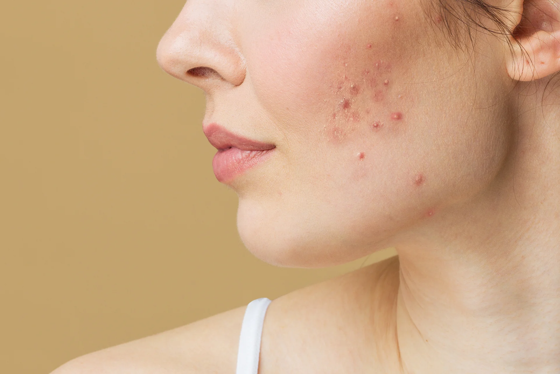 a portrait of a woman who had acne on her face