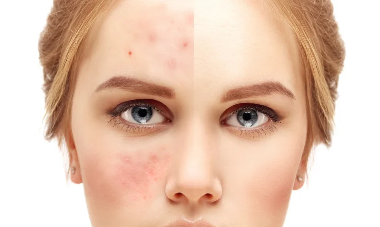 treating acne and acne scars